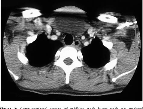 [pdf] Bronchogenic Cyst—a Rare Case Mimicking A Laryngocoele Semantic