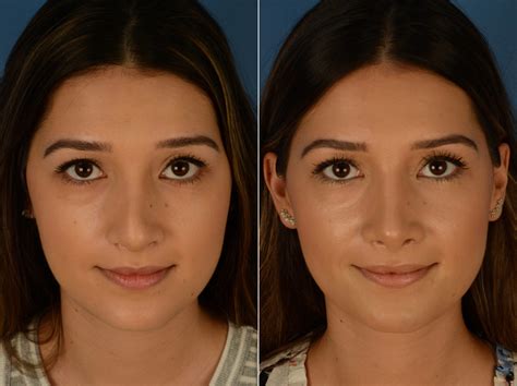 Revision Rhinoplasty Photos | Naples, FL | Patient 14996