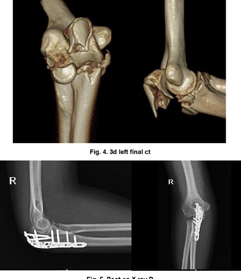 Figure 4 From Bilateral Transolecranon Fracture Dislocation Elbow With Bilateral Coronoid And