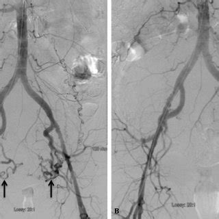 Magnetic Resonance Images Mri Before Uterine Artery Embolization