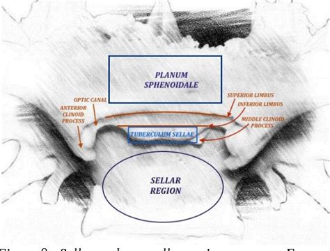 Figure 8 from THE PTERIONAL APPROACH IN A CASE OF PLANUM SPHENOIDALE ...