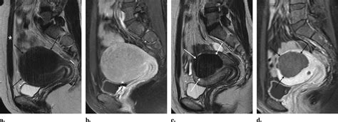 Uterine Artery Embolization For Symptomatic Adenomyosis A New