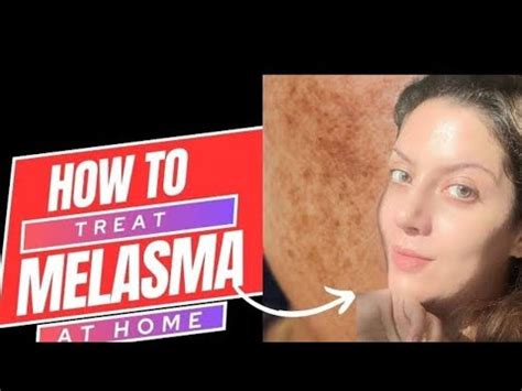 How To Remove Melasma At Home Melasma Treatment At Home Only Days