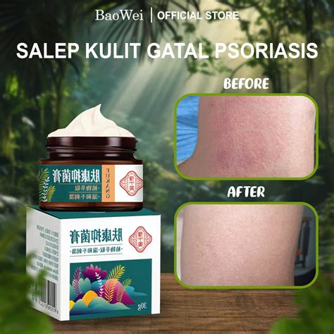 Jual Original 100 Krim Gatal Salep Gatal Psoriasis Salep Kulit Jamur Salep Eksim Shopee