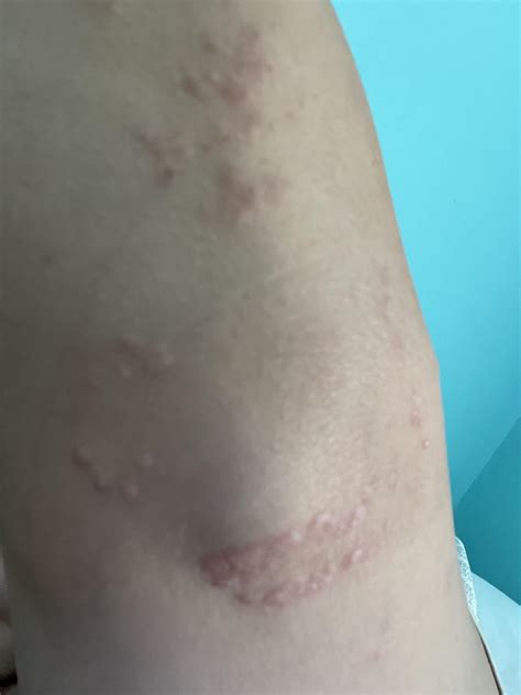 Weird bumps on my elbows. Started over a year ago in a small area, has