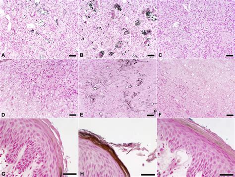 Fontana Masson Stain In Fungal Infections Journal Of The American