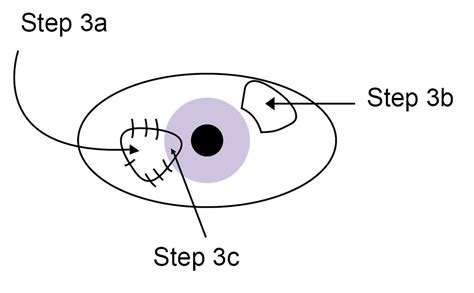 Pterygium And Pterygium Surgery