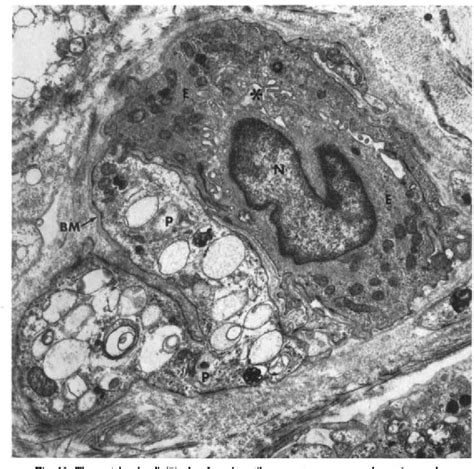 Figure From Mucolipidosis Ii I Cell Disease Ultrastructural