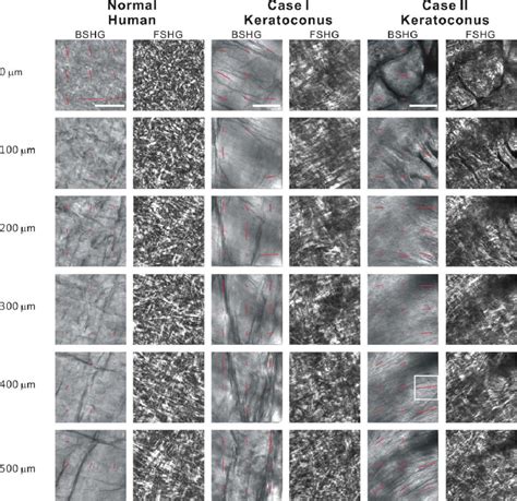 Bshg And Fshg Images Of Normal Human Cornea And The Two Cases Of