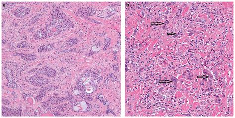 A Sclerosing Mucoepidermoid Carcinoma With Eosinophilia Composed Of