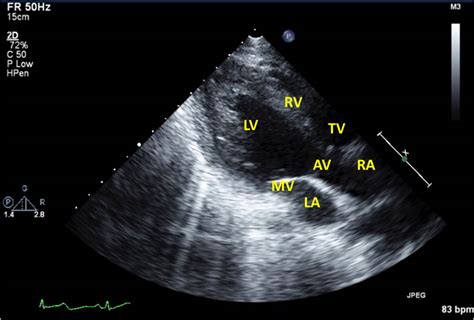 Figure 3 Reverse Takotsubo Basal And Midventricular Dysfunction Of