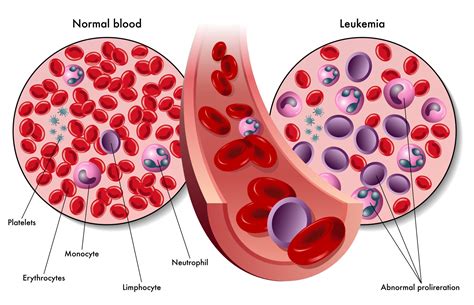 Leucemia Leucemia O Que E Tipos Causas Diagnostico E Tratamento Tua