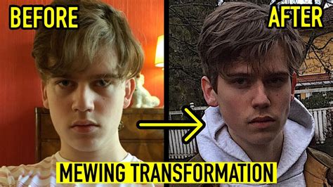 8 Month Mewing Transformation Video 19 Years Old Before And After