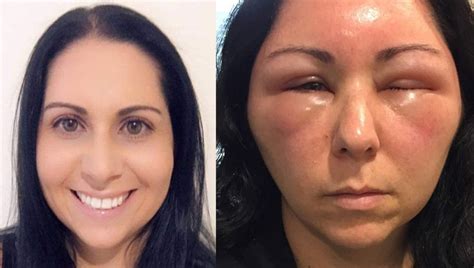 Woman's allergic reaction to hair dye causes severe swelling in face ...