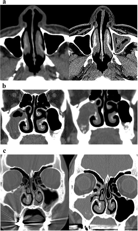 Fungal Ball Sinus Ct Scan At Lillian Malcom Blog