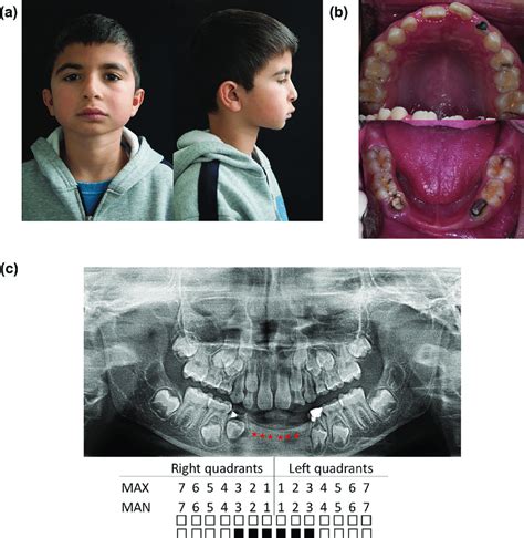 Clinical Findings Of The Proband A Facial Features Of The Proband