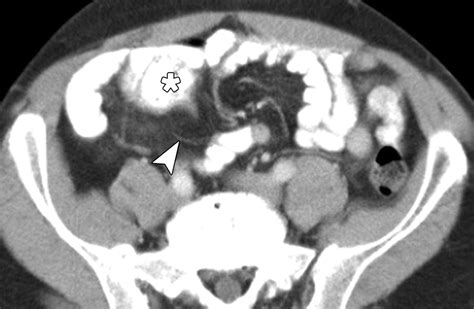 Mdct Diagnosis Of An Appendiceal Mucocele With Acute Torsion Ajr