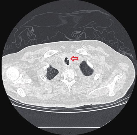 Tracheoesophageal Fistula Image Axial Chest Ct Images Show Download Scientific Diagram