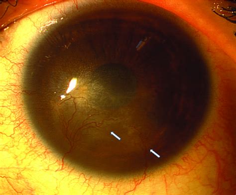 Acanthamoeba Keratitis Corneal Opacity And Vascularization Arrows