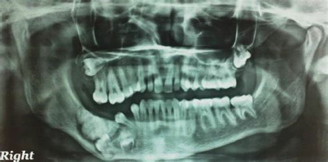 Orthopantomograph Showing Odontoma Displacing Permanent Mandibular