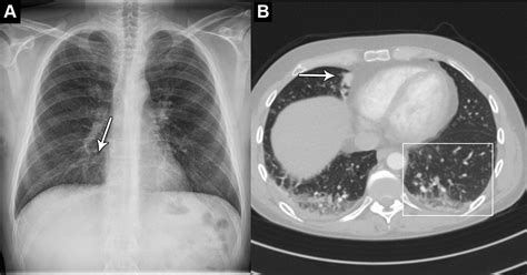 Autonomous Chest Radiograph Reporting Using Ai Estimation Of Clinical