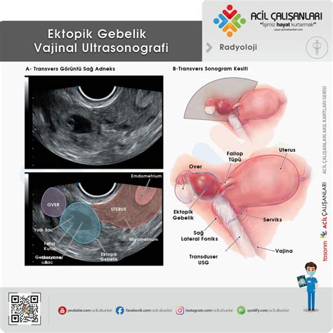 Ektopik Gebelik Acil Yaklaşım Acil Çalışanları