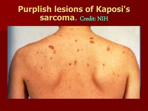 Ppt Kaposis Sarcoma Powerpoint Presentation Free Download Id5841