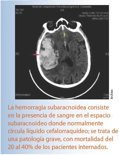 Hemorragia Subaracnoidea Sintomas Causas Factores De Riesgo Images