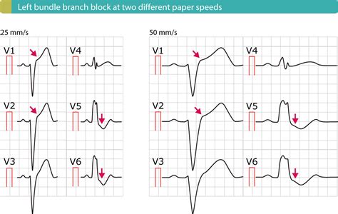 St Segment Elevation In Acute Myocardial Ischemia And Differential Diagnoses Cardiovascular