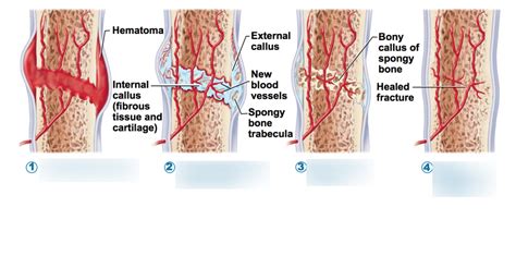 Bone Fracture Repair Diagram Quizlet