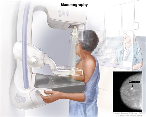 Breast Cancer Treatment Nci