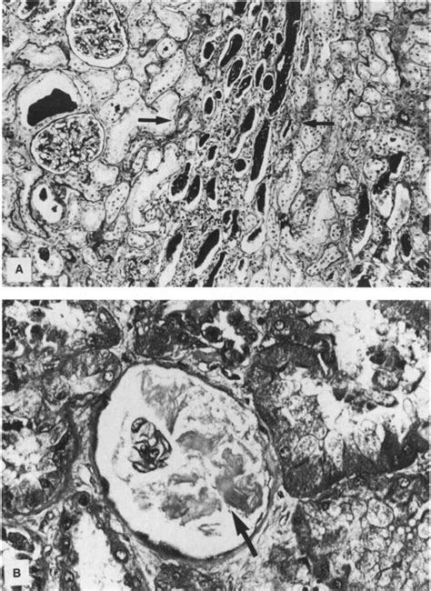 Pas Stain A Of Renal Biopsy Showing Stripe Like Tubular Atrophy Of