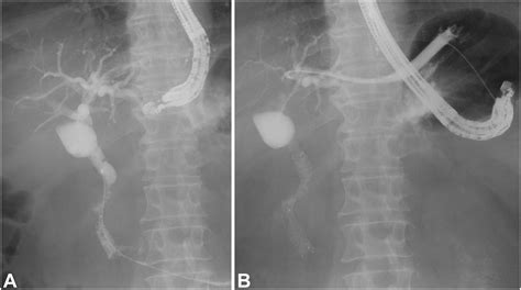 Eus Guided Hepaticogastrostomy Versus Eus Guided Hepaticogastrostomy