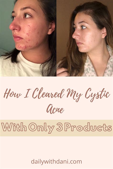 Acne Org Before And After How I Cleared My Cystic Acne Artofit