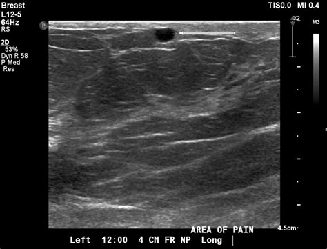 Mondor’s Disease Of The Breast An Uncommon Cause Of Atypical Chest Pain Eurorad