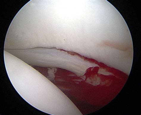 Hip Arthroscopy Minimally Invasive Keyhole Hip Surgery