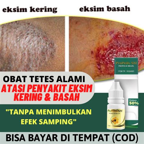 Obat Oles Eksim Kering Atau Basah Obat Penyakit Kulit Eksem