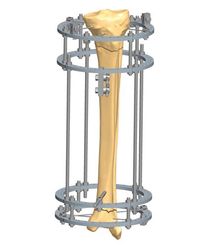 Tibia Bone Fracture Treatment Orthofix ABS