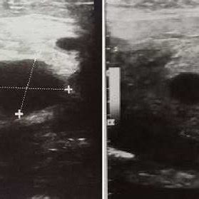 Cervical ultrasound showing inflammatory angulomaxillary adenopathy (A)... | Download Scientific ...