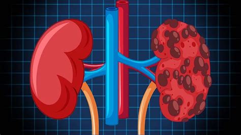 What Causes Kidney Damage
