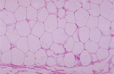 Lipoma Diagram