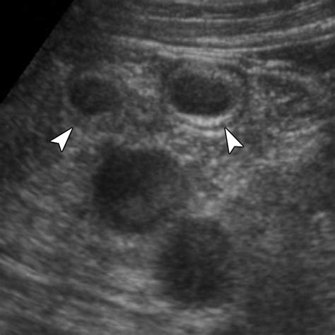 Ultrasound Imaging Of Bowel Pathology Technique And Keys To Diagnosis