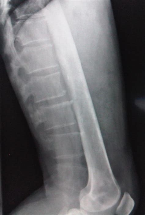 Lumbar Spine X Ray Lumbar Spine Positioning