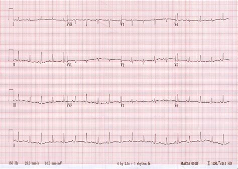 Cardiac Tamponade ECG Changes