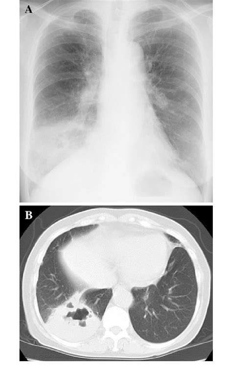 Chest X Ray A And Computed Tomography B On Admission Demonstrated A Download Scientific