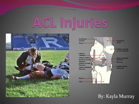 Ppt Acl Injuries Powerpoint Presentation Free Download Id 6508508