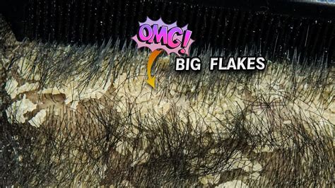 Dandruff Big Flakes Combing Dandruff Scratching Youtube