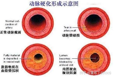 引起动脉硬化的3个原因： 知乎