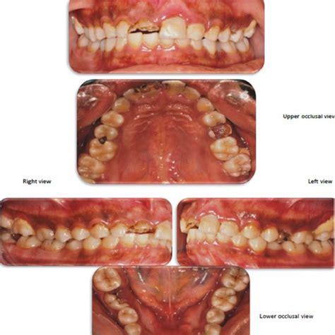 Classification of altered passive eruption | Download Table