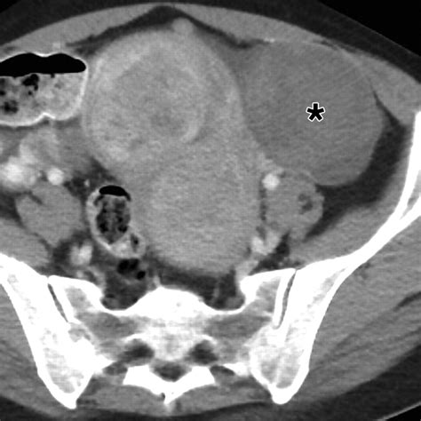 Ovarian Torsion Diagnostic Features On Ct And Mri With Pathologic